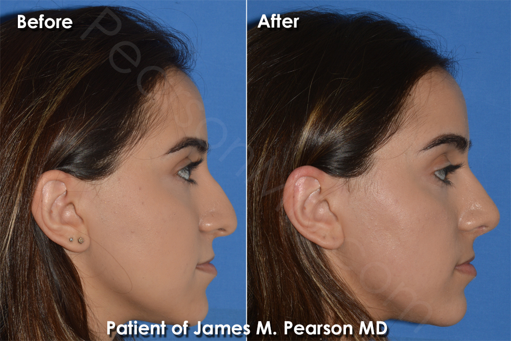 Dr. Pearson Rhinoplasty photos