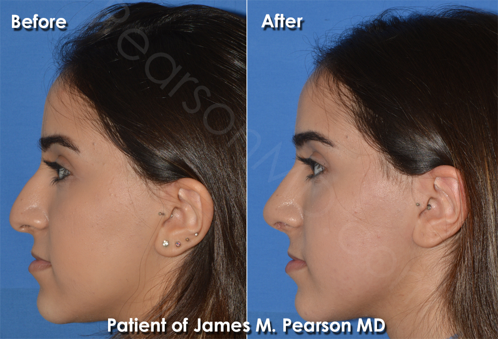 Pearson Rhinoplasty photos