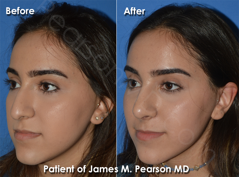 Pearson Nasal Surgery photos