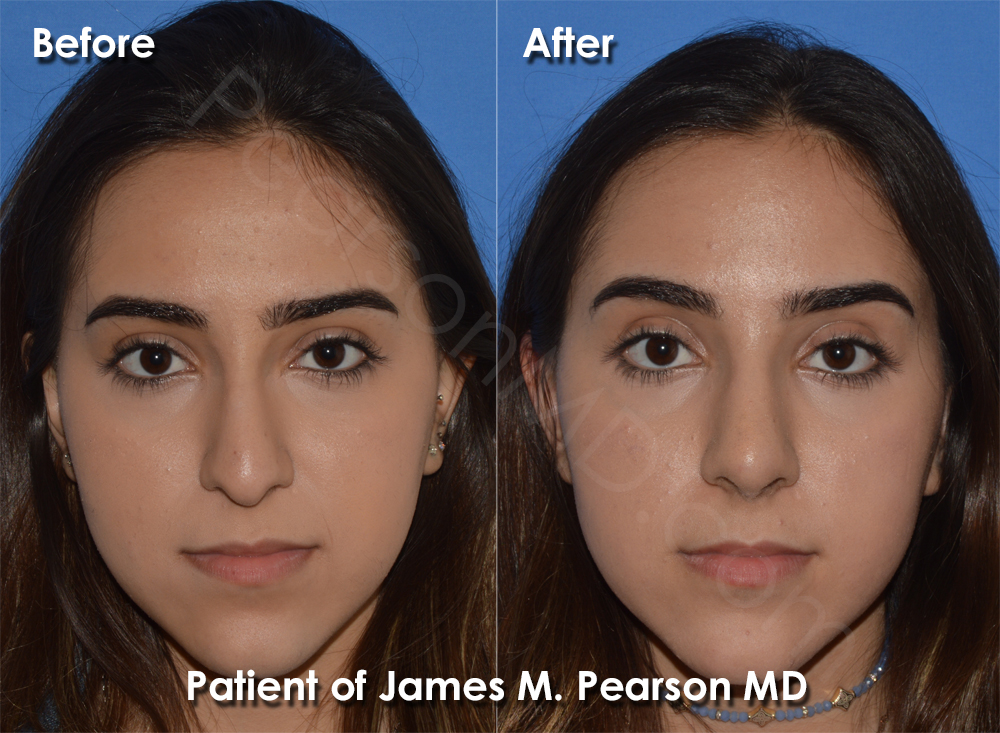 Pearson Cosmetic Nasal Surgery photos