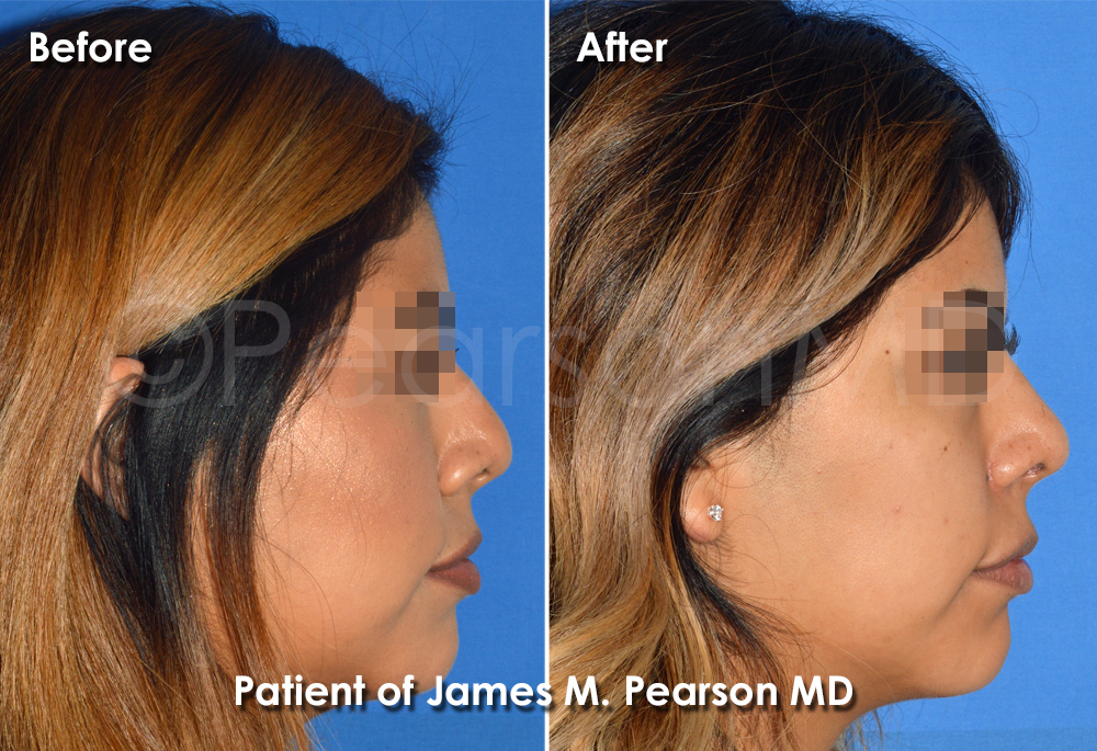 Dr. Pearson Rhinoplasty photos