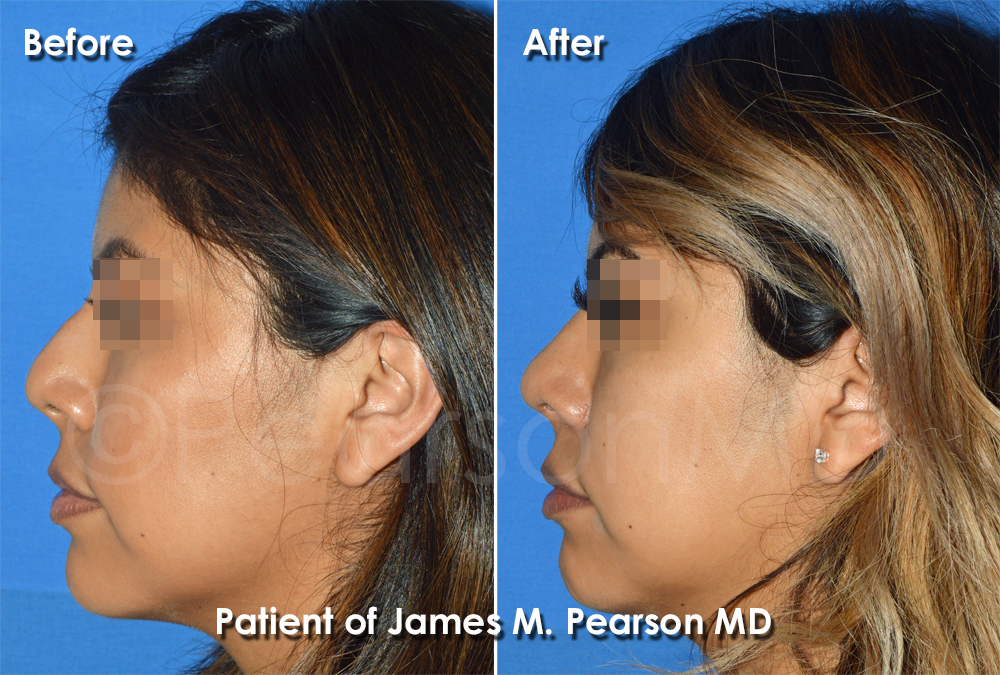 Pearson Rhinoplasty photos