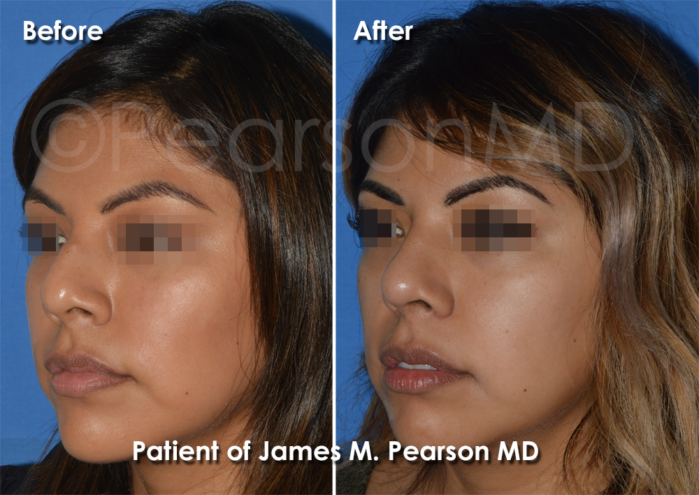 Pearson Rhinoplasty photos