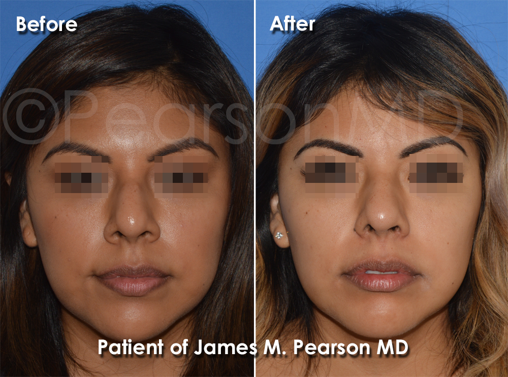 Dr. Pearson Rhinoplasty photos