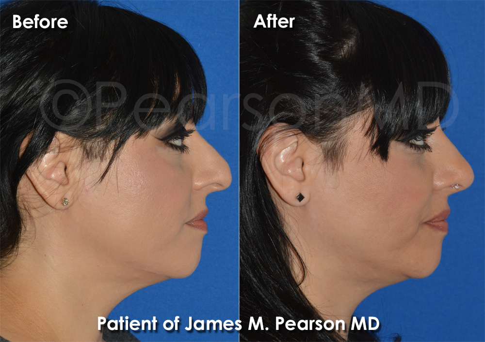 Dr. Pearson Rhinoplasty