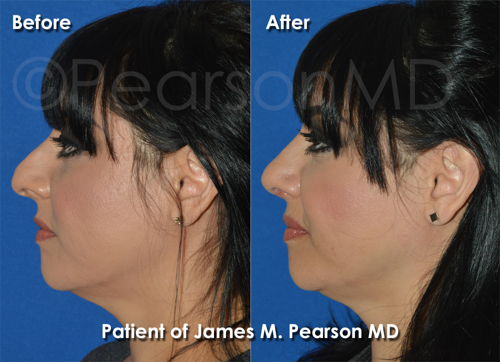 Redondo Beach Rhinoplasty