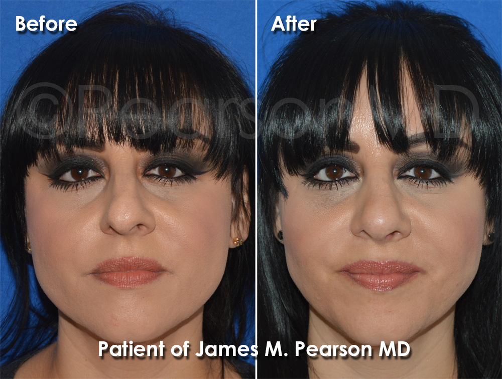 Manhattan Beach Rhinoplasty