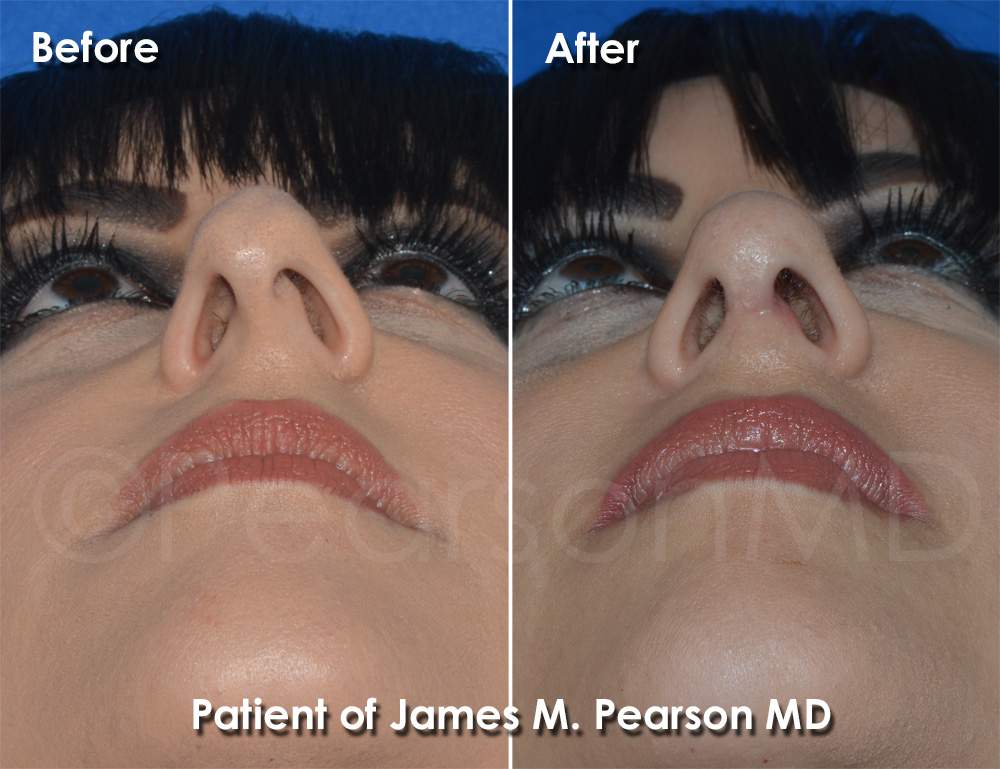 Torrance Rhinoplasty