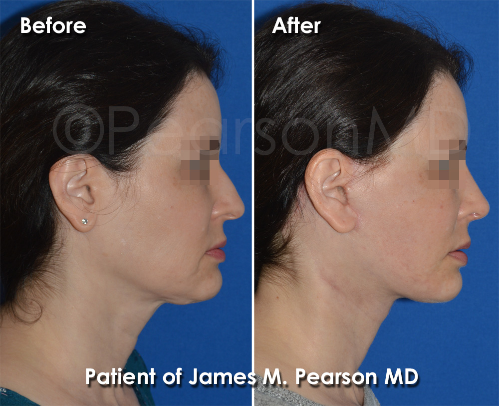 Rhinoplasty