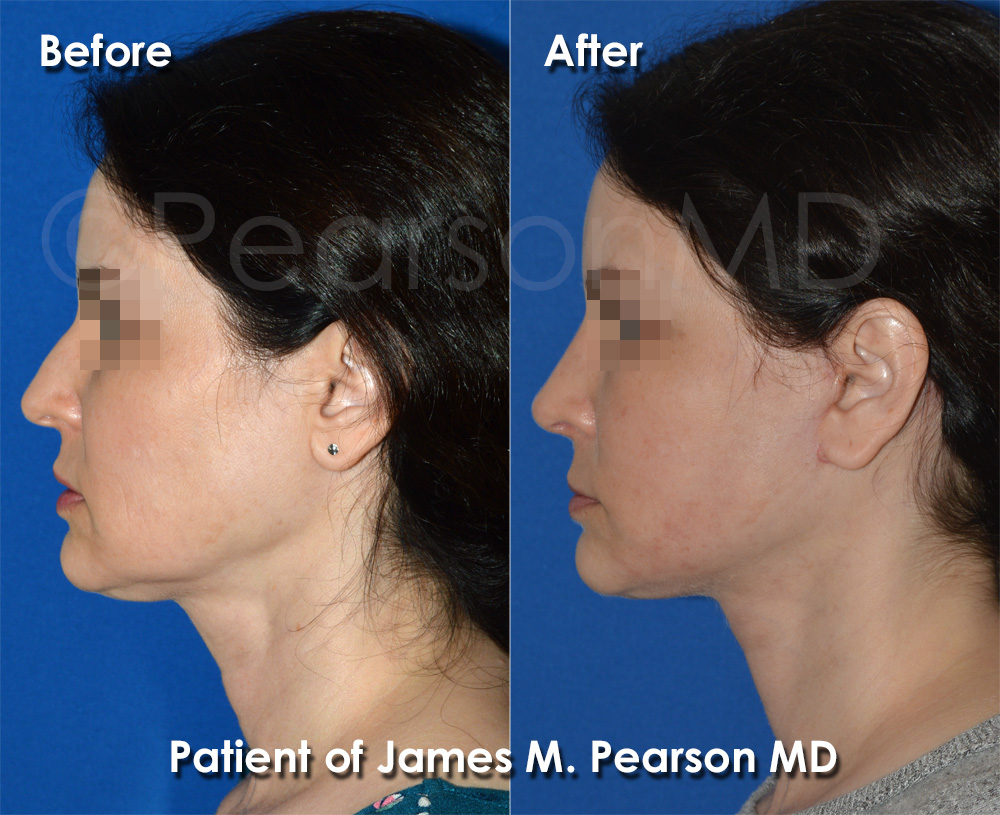 Palos Verdes Rhinoplasty