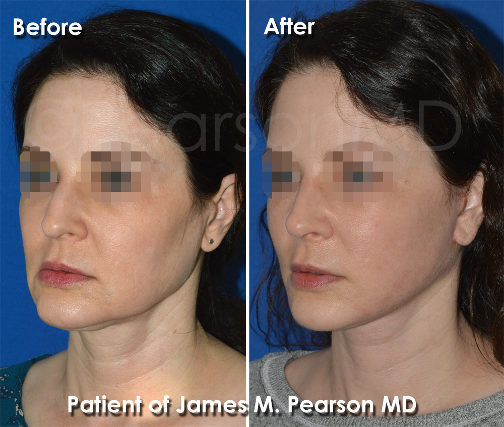 Hermosa Beach Rhinoplasty