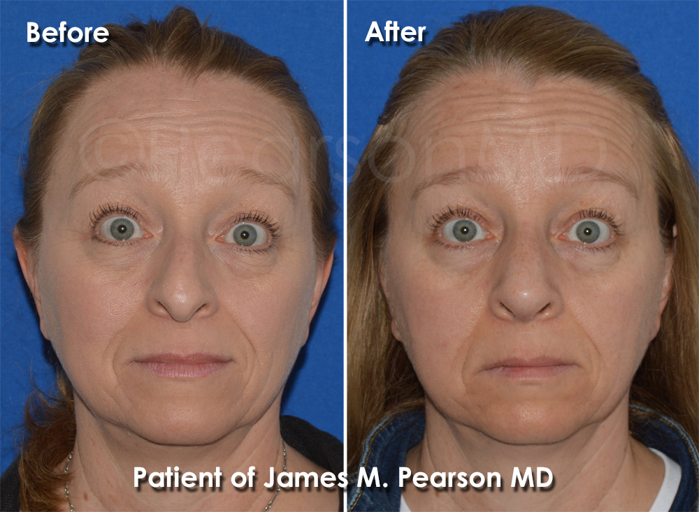 Palos Verdes Rhinoplasty