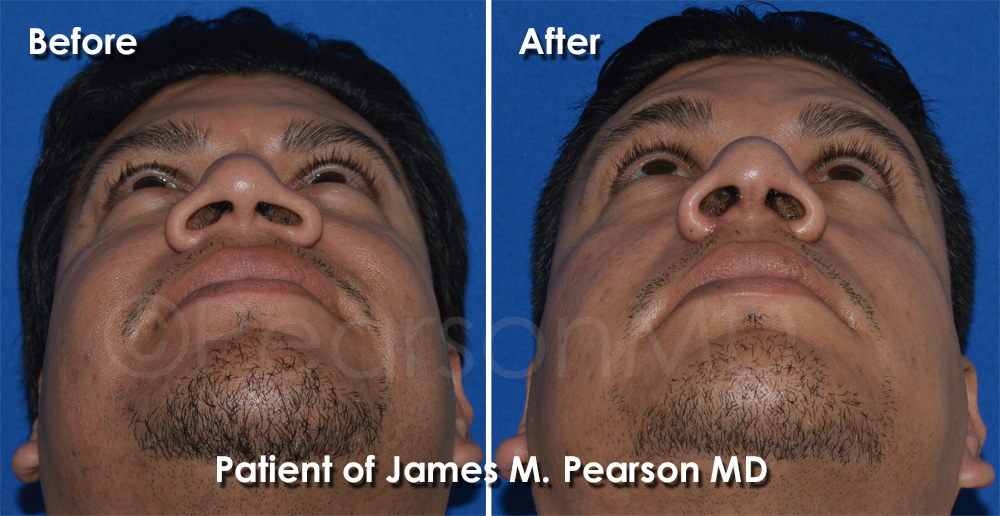 Nasal Base Reduction
