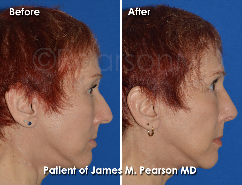 Pearson Plastic Surgery