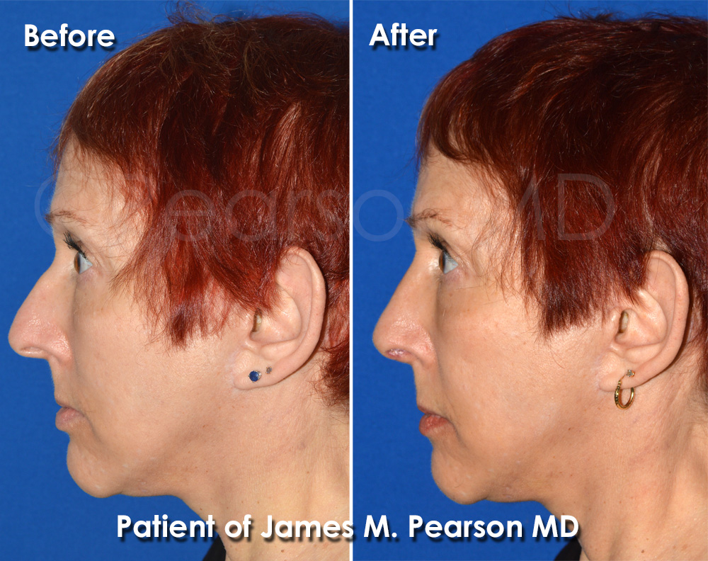 Dr. Pearson Rhinoplasty