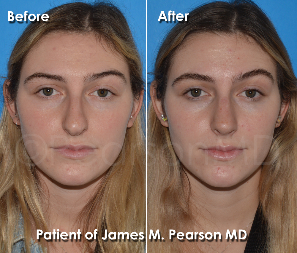 Pearson Rhinoplasty