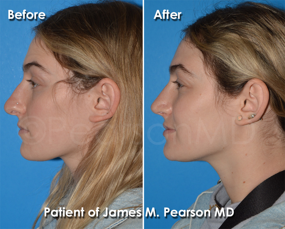 Dr. Pearson Rhinoplasty