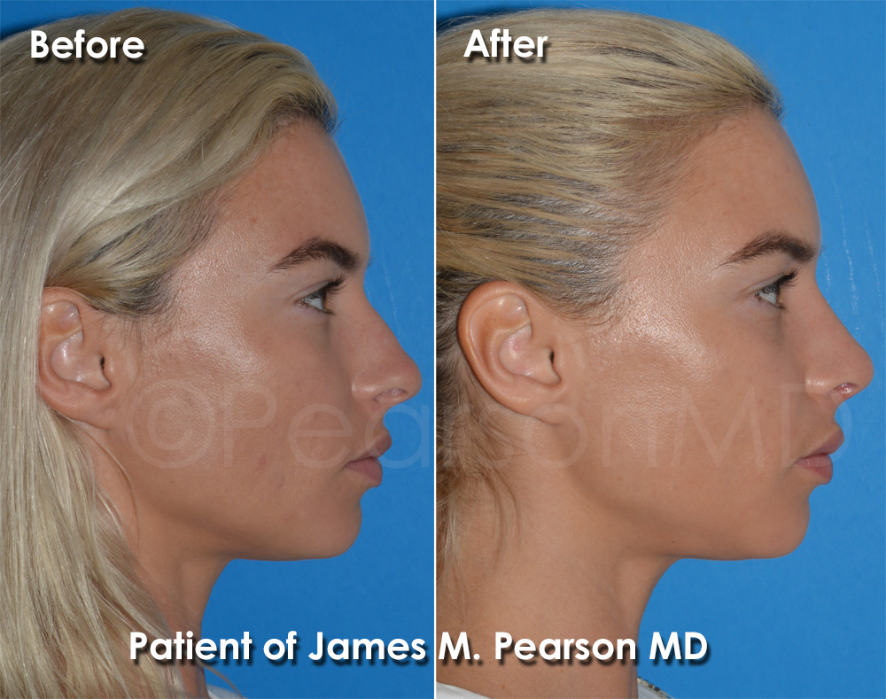 Rhinoplasty Torrance