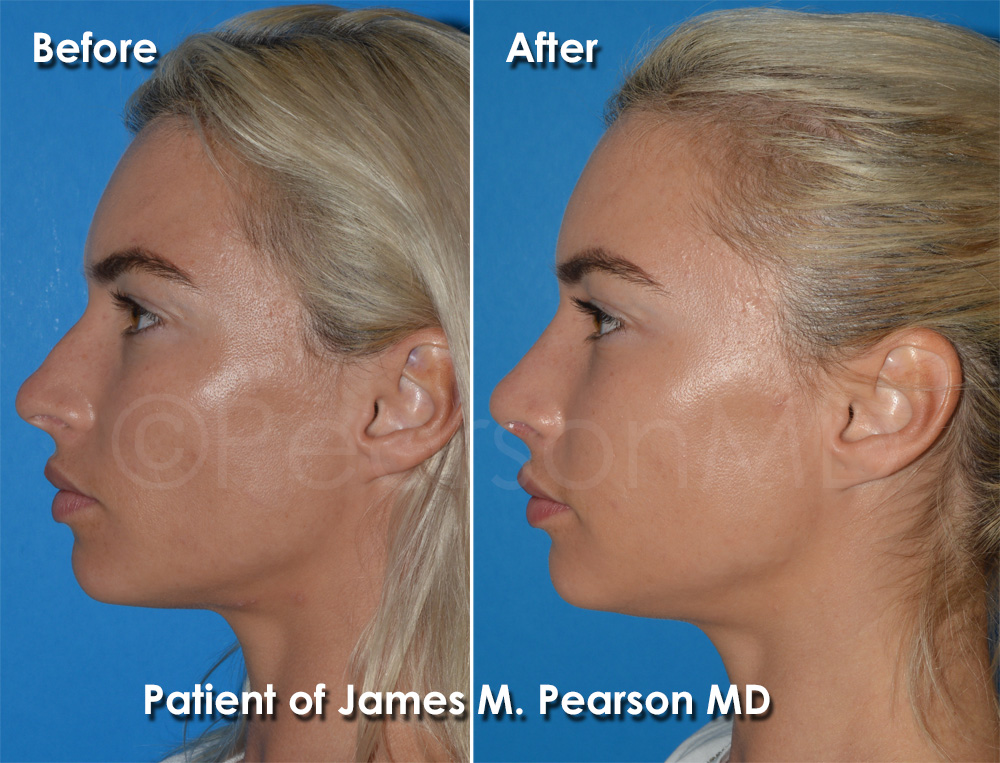 Rhinoplasty Hermosa Beach
