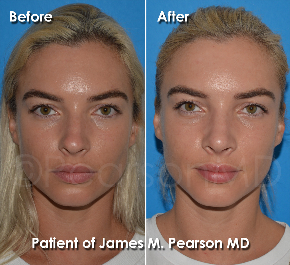 Dr. Pearson Rhinoplasty