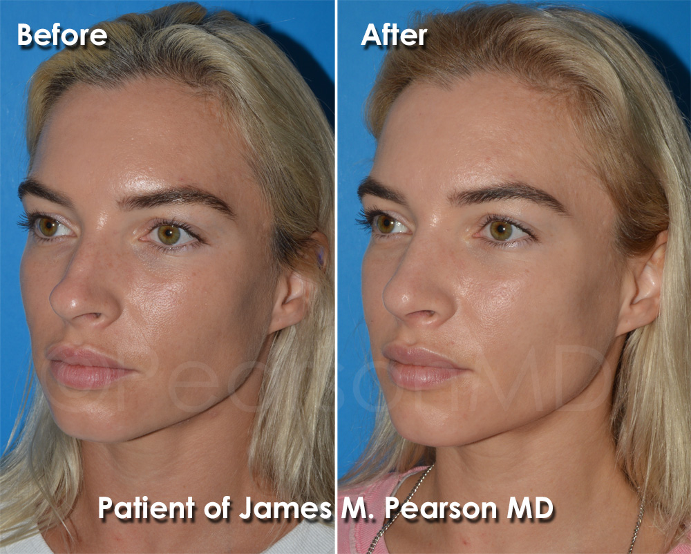 Pearson Nasal Surgery