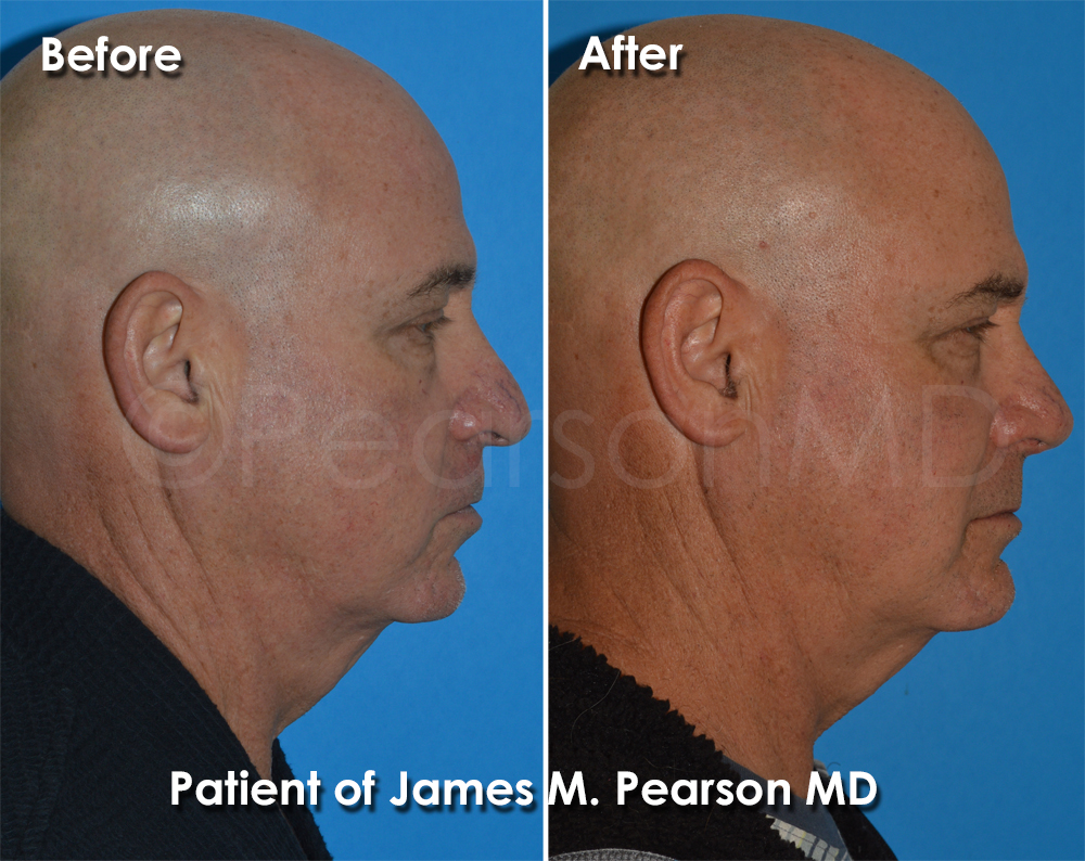 Dr. Pearson Rhinoplasty