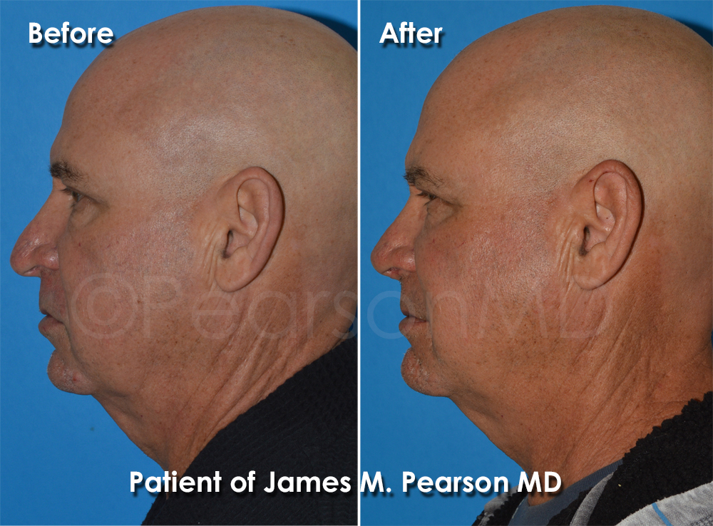 Pearson Rhinoplasty