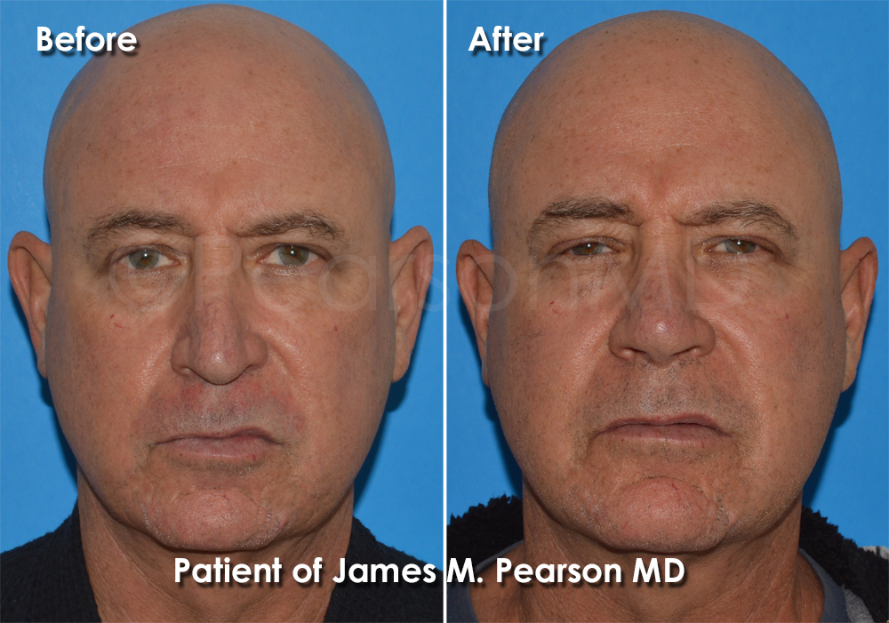 Dr. Pearson Plastic Surgeon