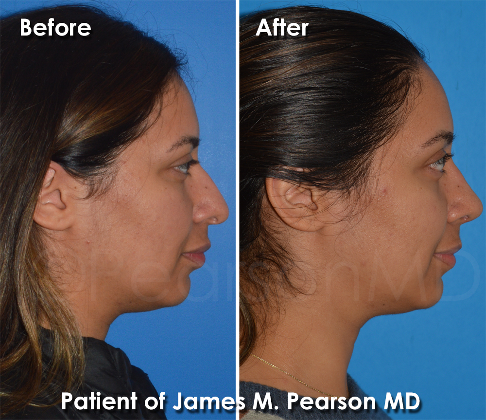 Dr. Pearson Rhinoplasty