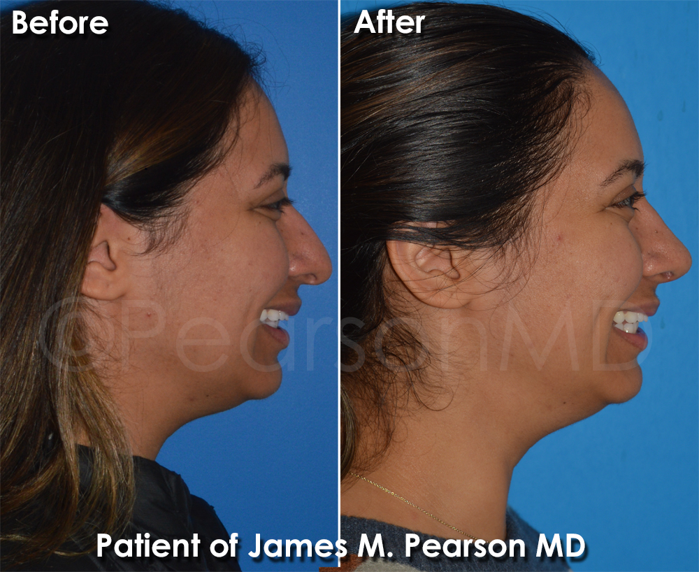 Dr. Pearson Plastic Surgeon