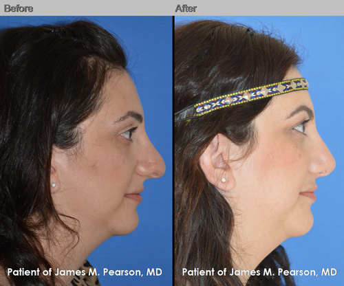 Photos Pearson Middle Eastern Rhinoplasty Nosejob