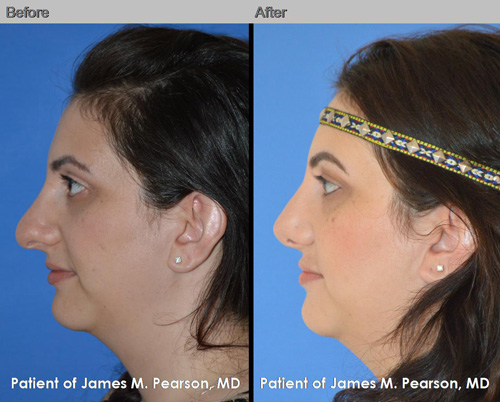 Photos Pearson Middle Eastern Rhinoplasty Nosejob
