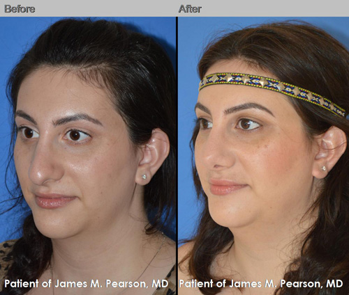 Photos Pearson Middle Eastern Rhinoplasty Nosejob