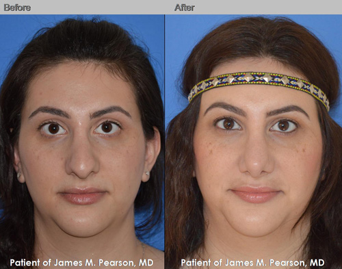 Photos Pearson Middle Eastern Rhinoplasty Nosejob