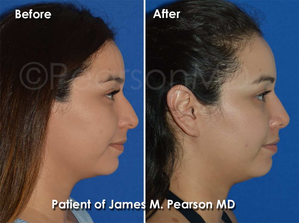 Pearson Nasal Surgery