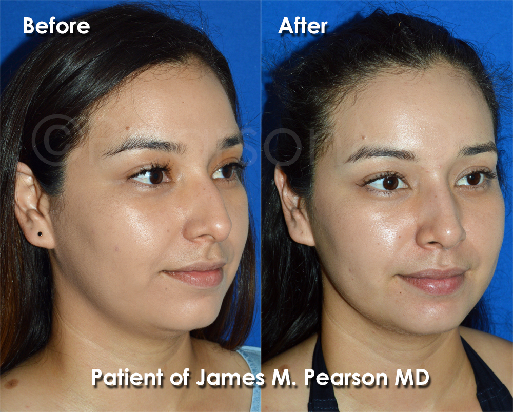 Pearson Nose Job
