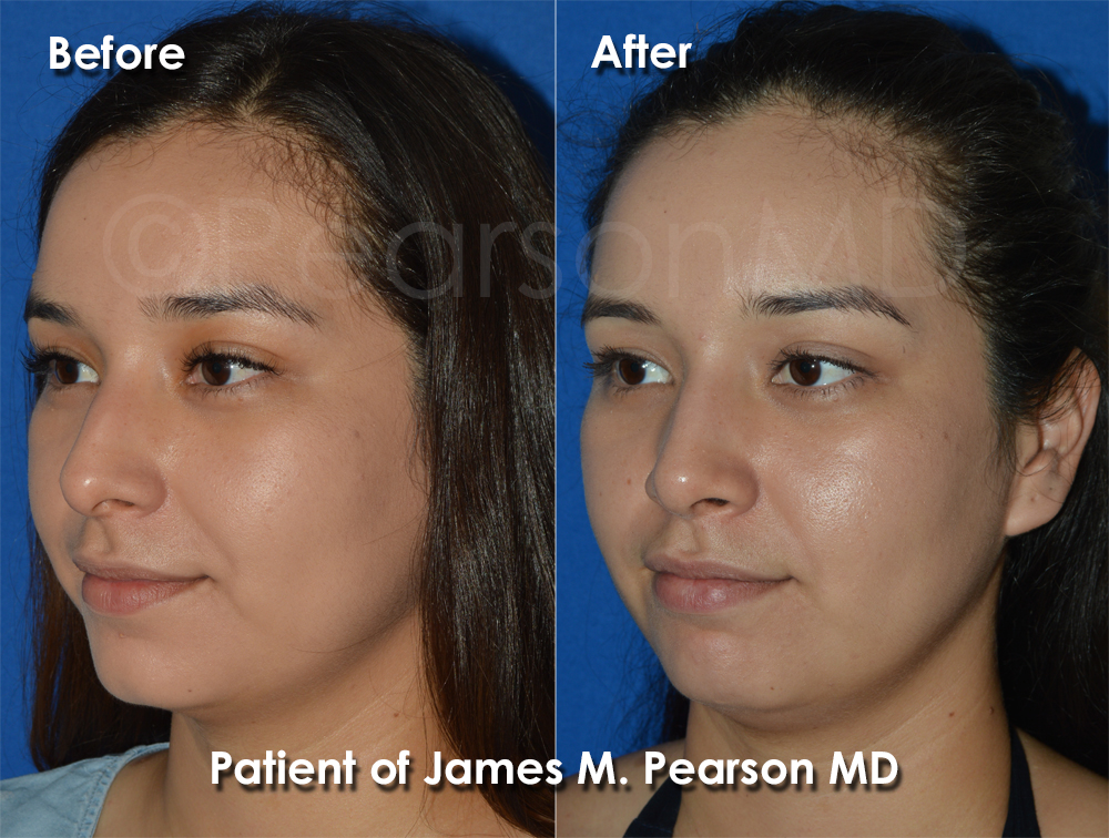 Pearson Rhinoplasty