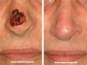 skin cancer repair before and after photo