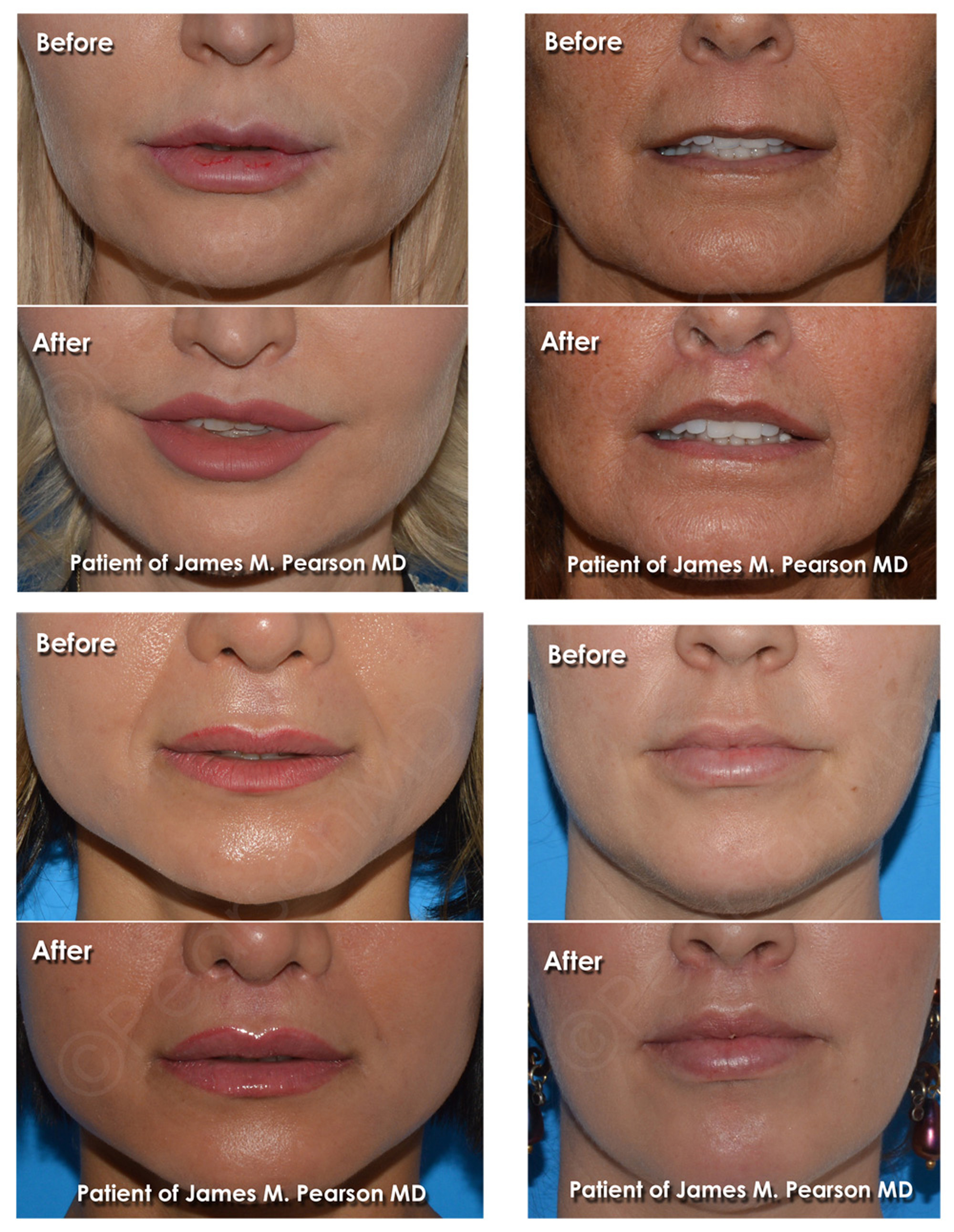 Lip Lift Before and After Results - Patient of James M. Pearson MD