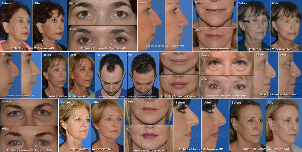 Before and After Patient Results - Dr. James Pearson