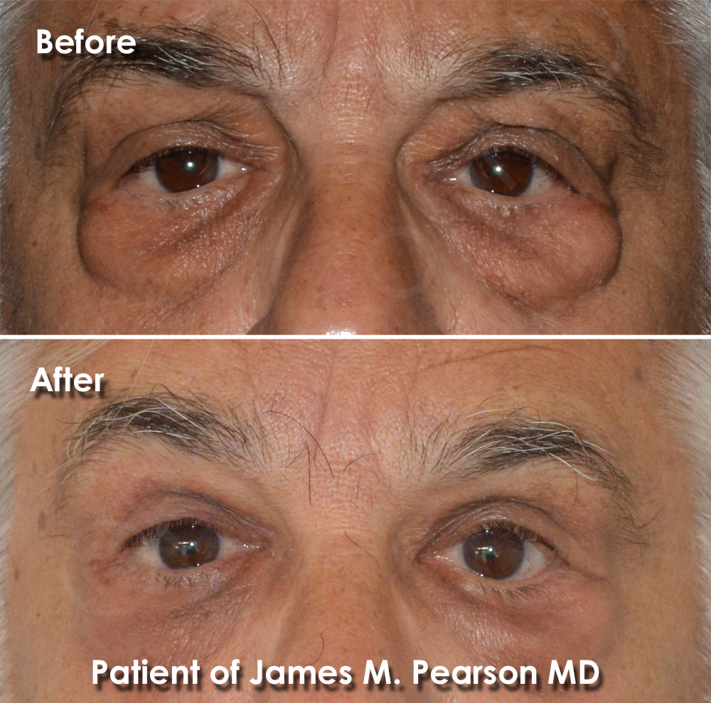 Pearson Eyelid Surgery