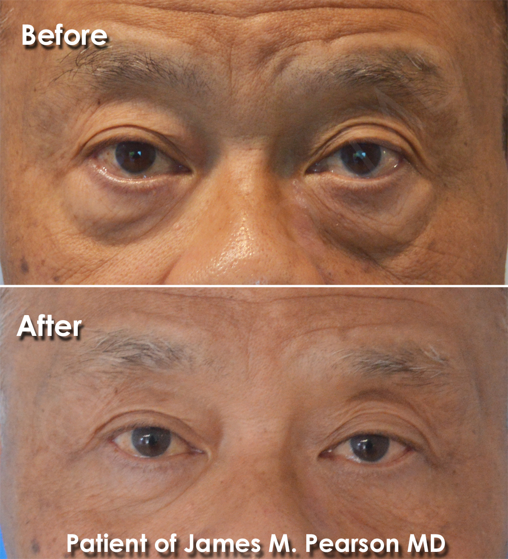 Dr. Pearson Facial Plastic Surgeon