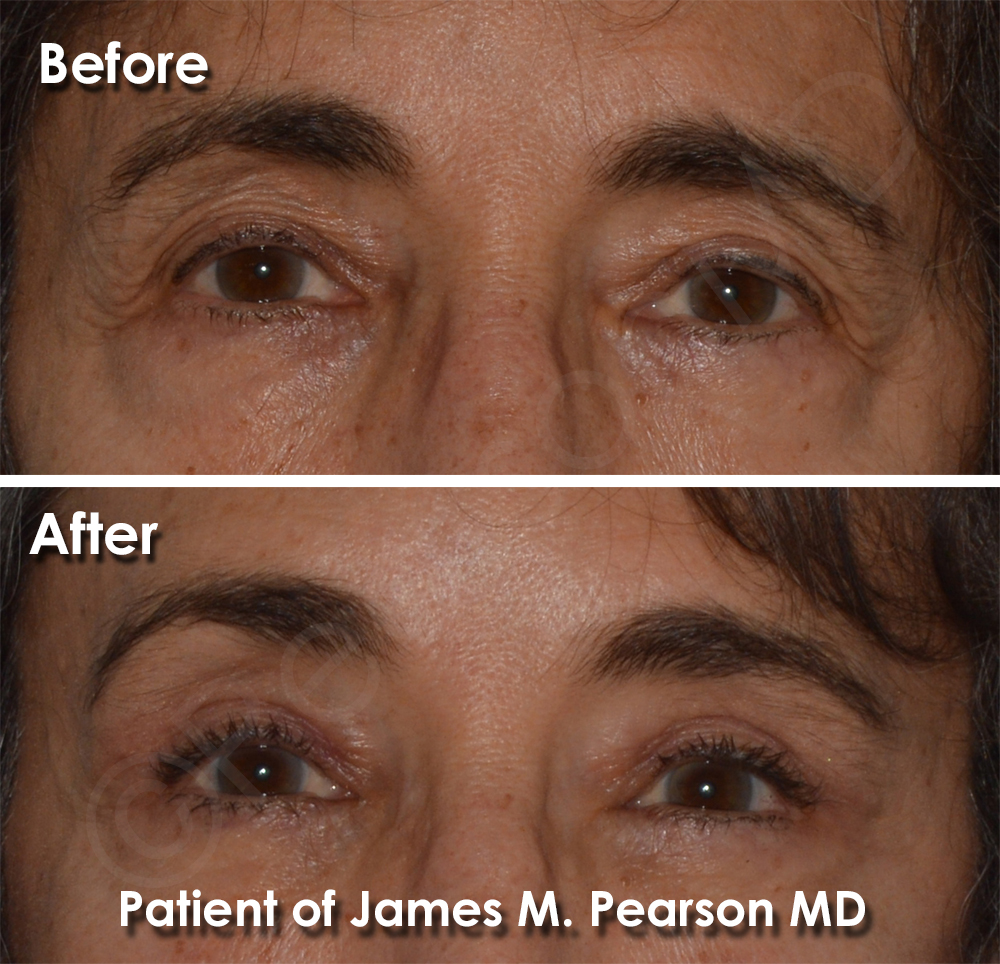 Brow Lift Dr. Pearson