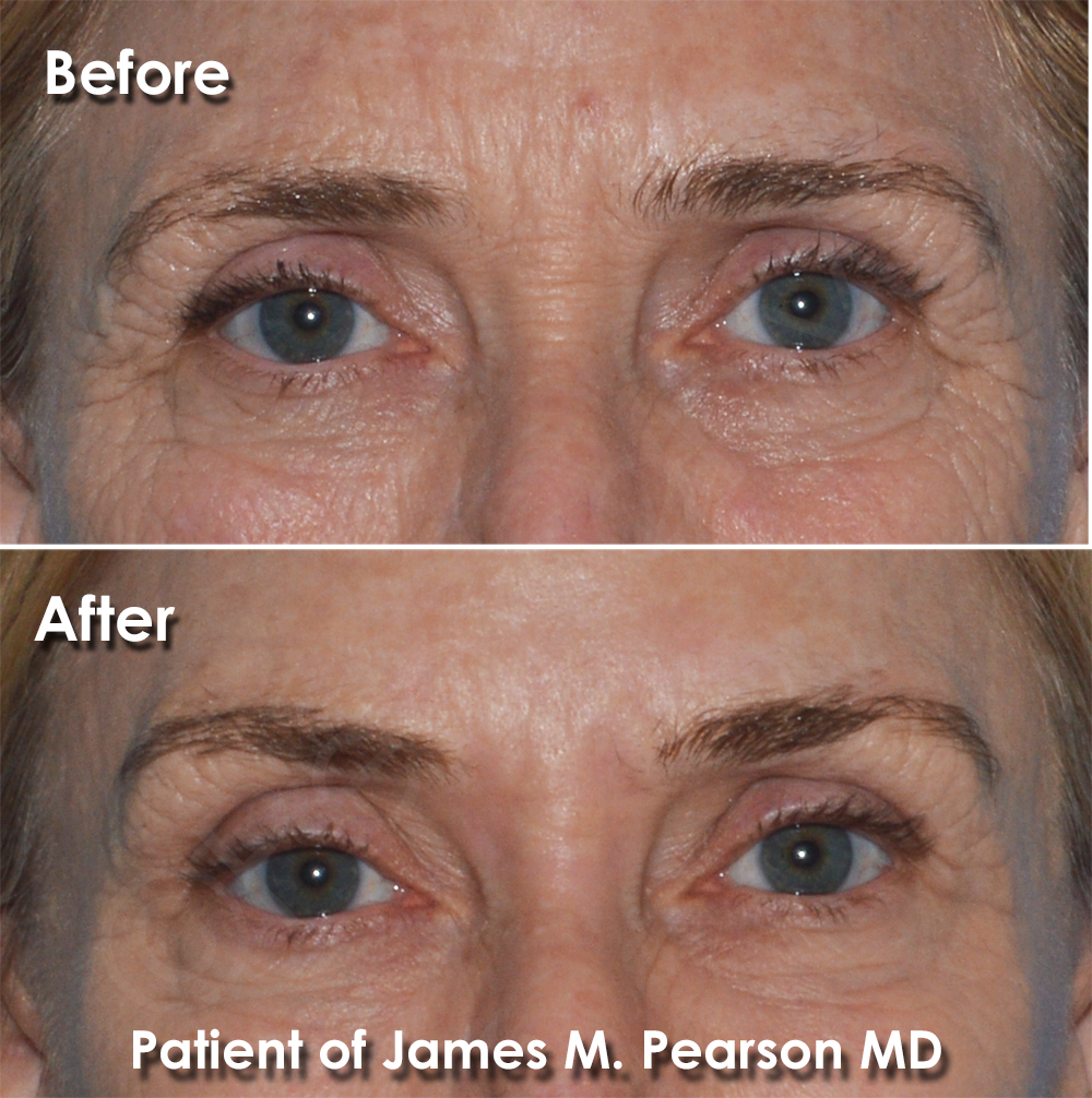 Brow Lift Dr. Pearson
