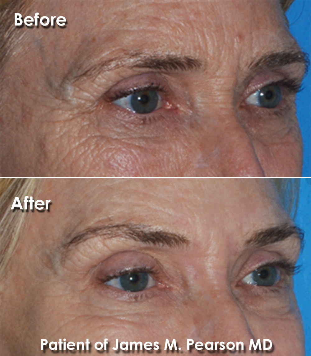Brow Lift Pearson Plastic Surgery