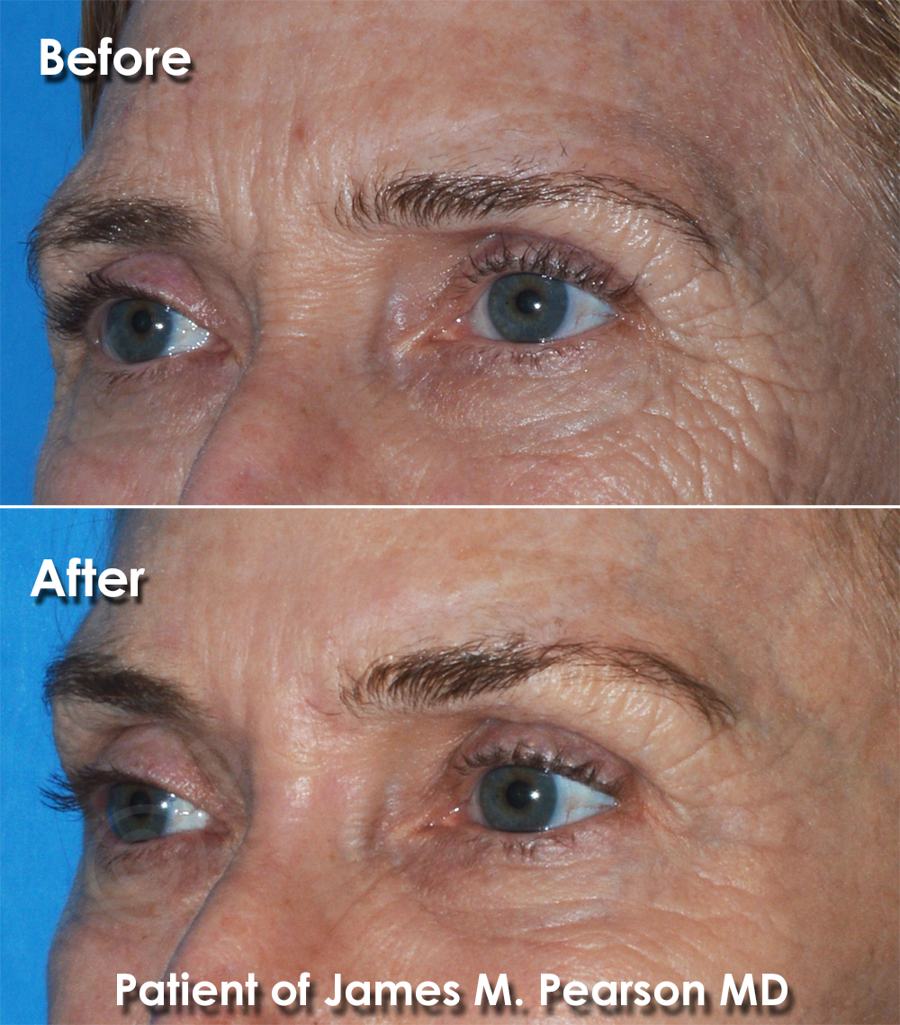 Brow Lift Dr. Pearson