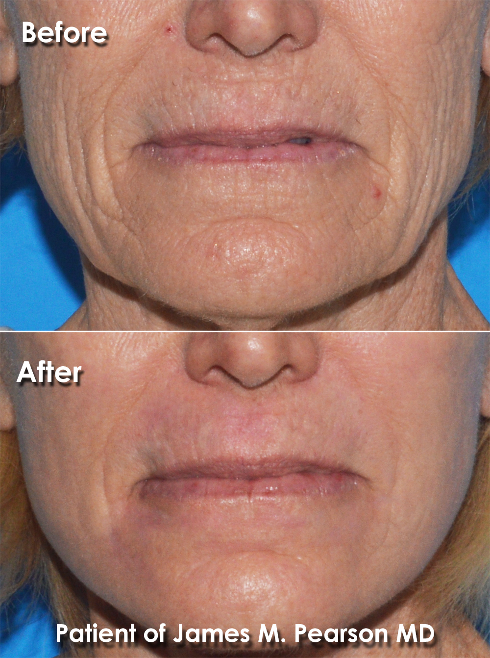 Dermabrasion Resurfacing Pearson Plastic Surgery