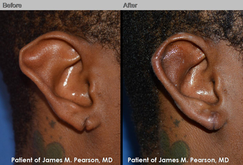 Photos Dr. Pearson Ear Plastic Surgery