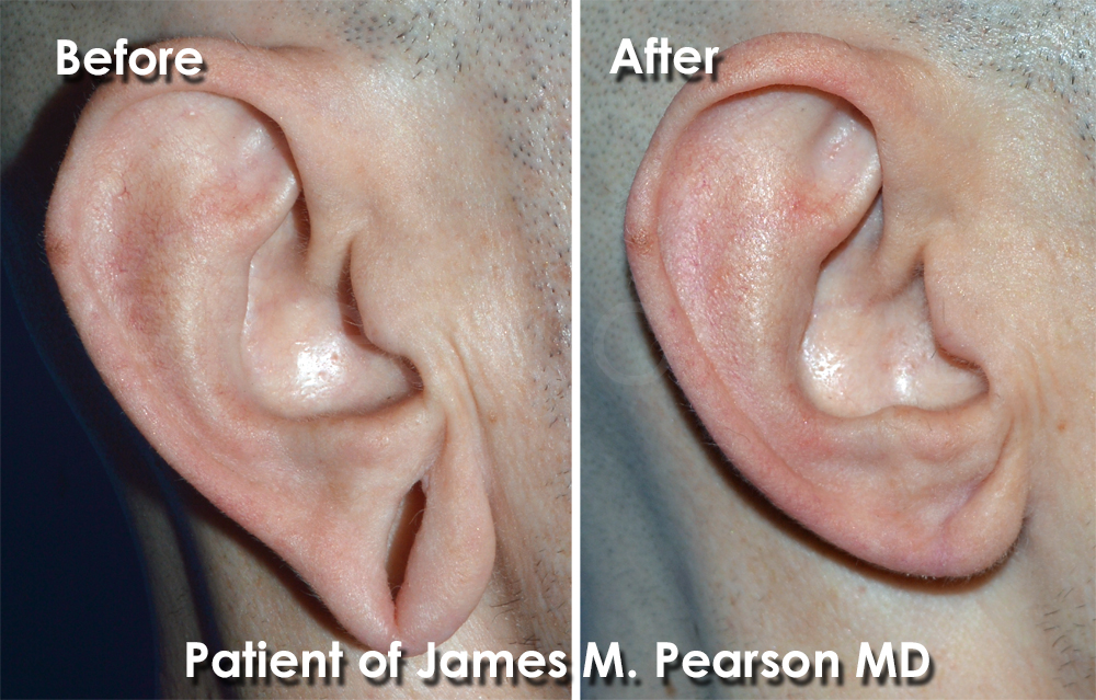 Earlobe Gauged Photos