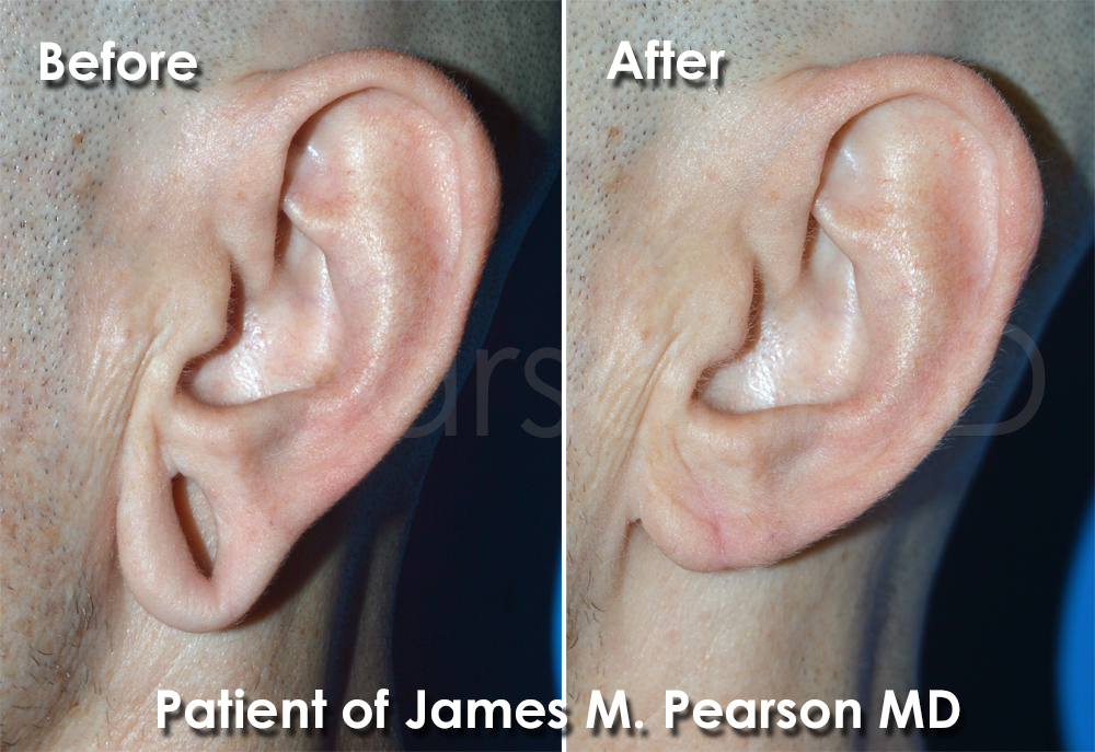 Earlobe Gauged Photos